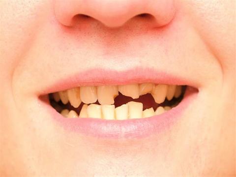 أسباب متلازمة تشقق الأسنان وكسرها وطرق علاجها