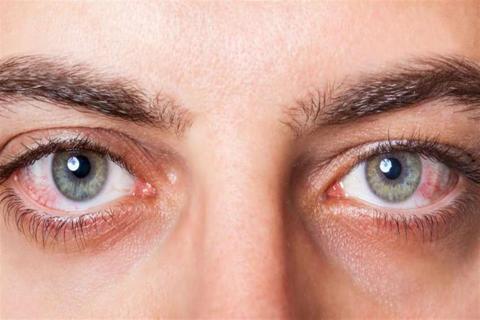 متى يتطلب علاج جفاف العين إجراء جراحة؟