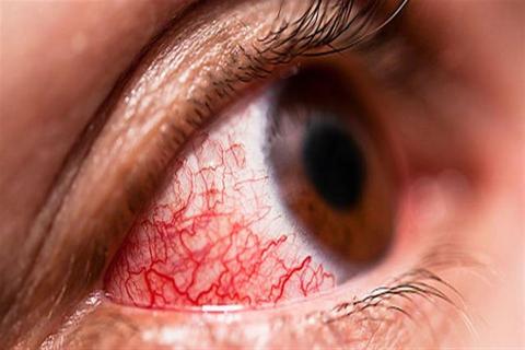 كيف يؤثر ارتفاع الكوليسترول على صحة العين؟.. استشاري يجيب