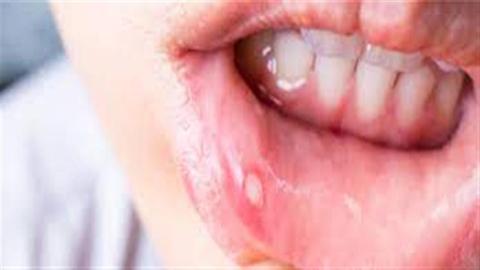 تجنبها- عوامل تزيد من خطر الإصابة بتقرحات الفم