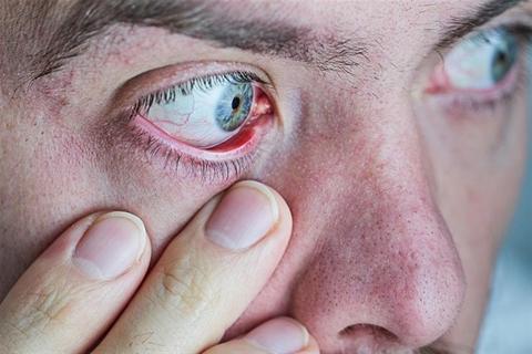 س & ج- دليل شامل عن التهاب العين البكتيري
