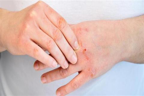 3 أنواع من التهابات الجلد تهددك في فصل الصيف