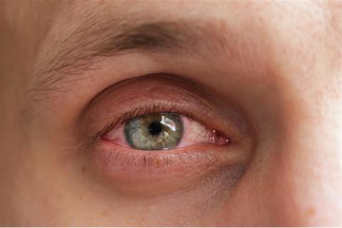 6 طرق للتخلص من تدميع العين أثناء نزلة البرد