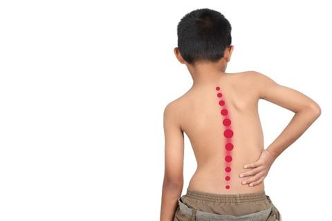 اعوجاج العمود الفقري عند الأطفال- كيف يمكن
