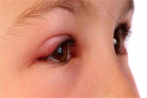 تورم العين المفاجئ عند الأطفال.. إليك الأسباب
