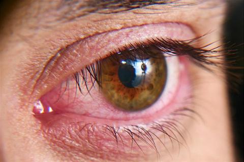 هل كثرة العماص حول العين دليل على الإصابة