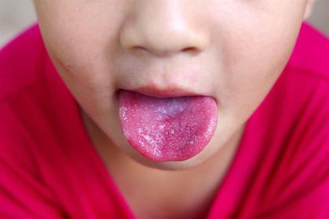 4 مشكلات صحية قد تسبب حبوب حمراء على لسان طفلك
