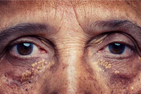 مضاعفات ارتفاع الكوليسترول- 4 أمراض يسببها للعين
