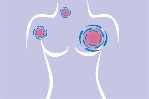 طبيب يوضح أخطر أنواع سرطان الثدي 