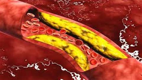 اكتشاف سبب غريب وراء ارتفاع الكوليسترول في الدم
