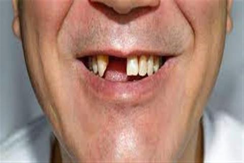 دواء سحري يعيد نمو الأسنان بعد الخلع