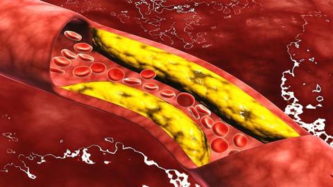 تمارين تخفض الكوليسترول الضار في الدم