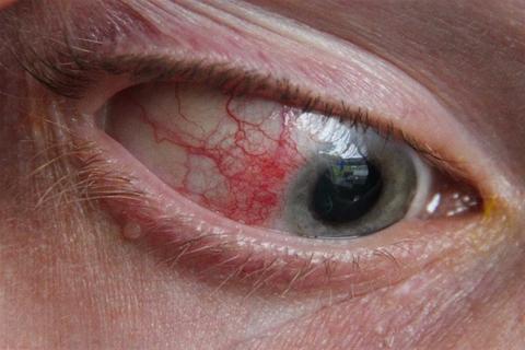 احذر- التهاب المفاصل الروماتويدي يهدد عينيك