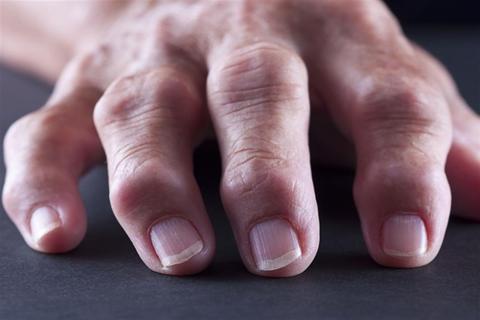 أعراض الفشل الكلوي- 4 علامات تظهر على اليدين