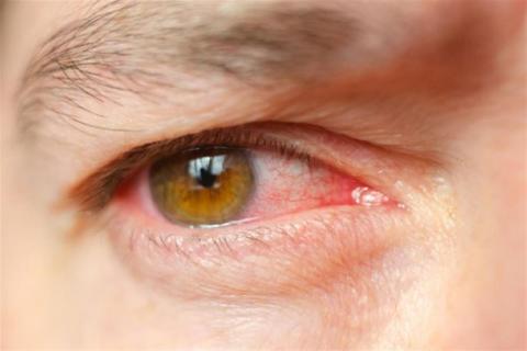 كيف تؤثر أمراض القلب على العين؟
