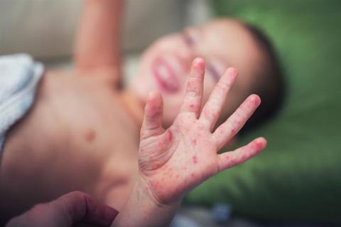 س & ج- دليل شامل عن فيروس اليد والقدم والفم عند