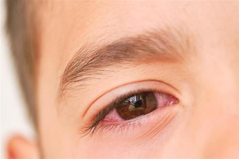 احمرار العين عند الأطفال- 5 طرق طبيعية لعلاجه