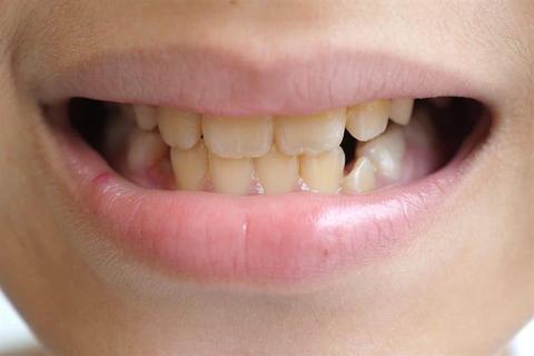 طبيب يحذر: نقص هذا المعدن يسبب اصفرار الأسنان