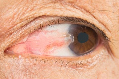 ماذا يحدث إذا تركت ظفرة العين بدون علاج؟
