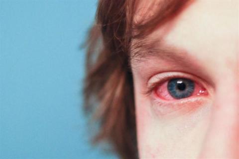 في 9 خطوات- دليلك للوقاية من حساسية العين في